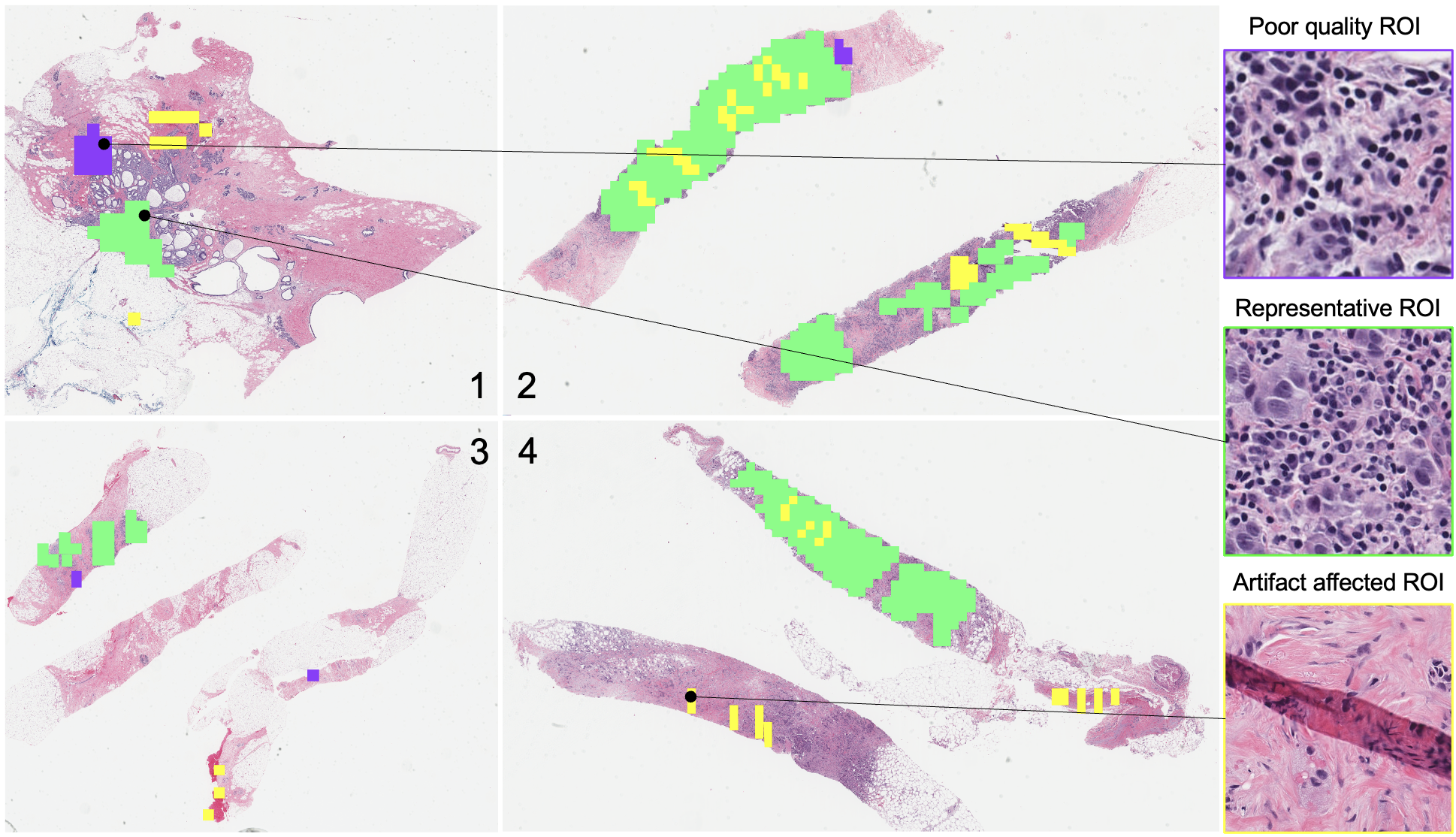 Region of interest (ROI) selection using vision transformer for automatic analysis using whole slide images
