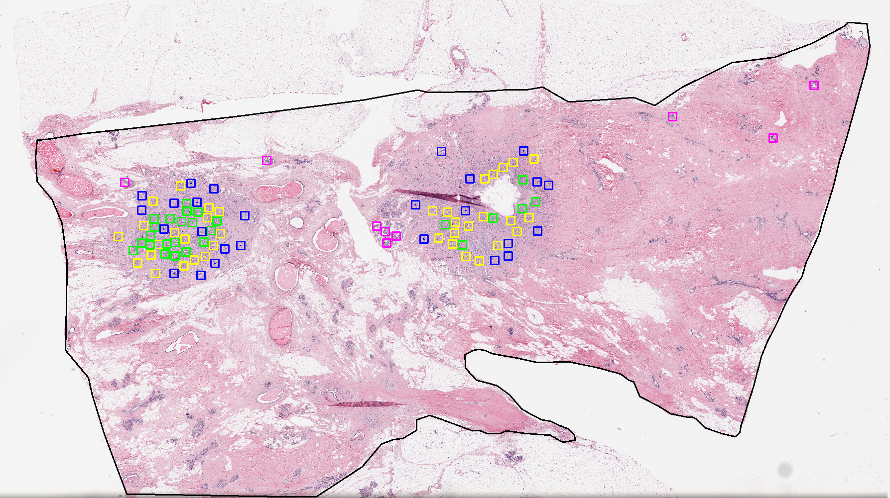 Residual Tumor Cellularity Assessment After Neoadjuvant Therapy