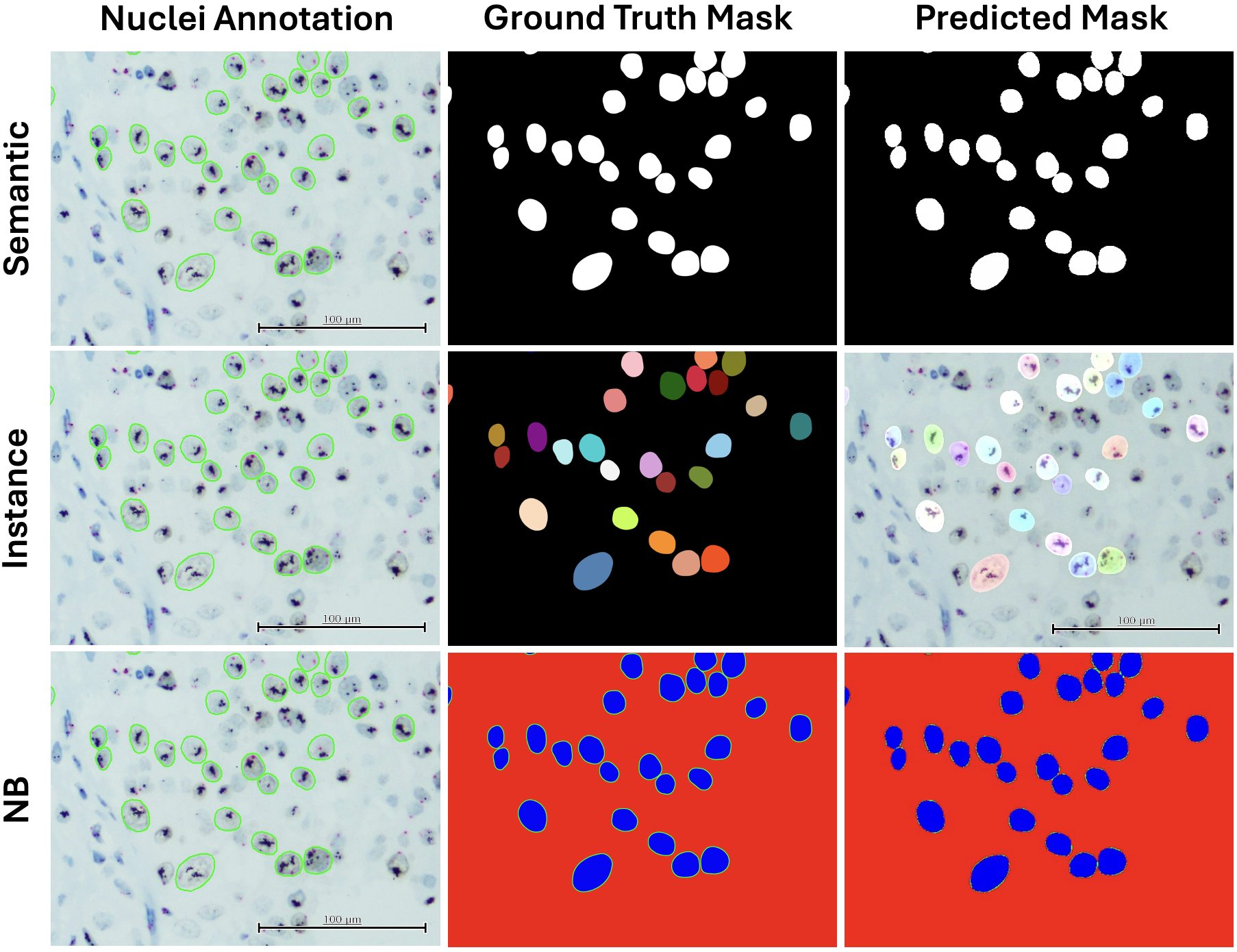 SiNuS: A Comprehensive Dataset for Singular Nuclei Segmentation for HER2 Grading of Breast Cancer